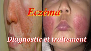 Eczéma diagnostic et traitement [upl. by Primaveras]