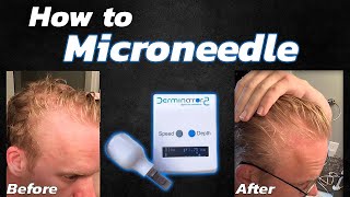 How to Microneedle for Hair Loss Using the Derminator 2 [upl. by Alta335]