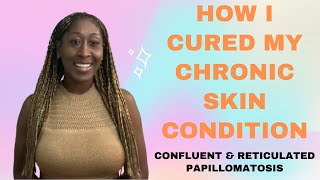 My Wellness Journey Ep 2 How I Conquered CARP Acne and Chronic Skin Issues [upl. by Ariaek540]