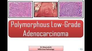 Polymorphous Low grade adenocarcinoma [upl. by Ellives]