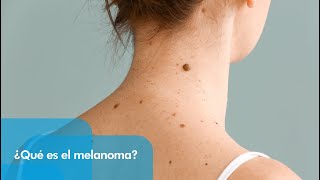 QampA Dermatología ¿qué es el melanoma [upl. by Anjela]