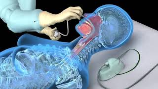 Nasotracheal suctioning NTS  3D animation [upl. by Sholes]