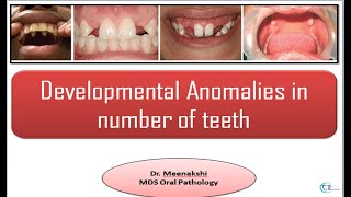 Developmental Disturbances in Number of teeth [upl. by Valerio]