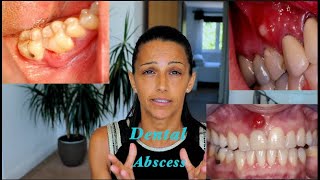 How to treat a Dental Abscess Different Natural Mouthrinses and their uses [upl. by Rramed356]