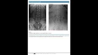 Presenting The SpineTech PRO Chiropractic Report of Findings Page by Page [upl. by Bobina]