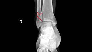 Fibula Fracture Xray 51 [upl. by Ornas877]