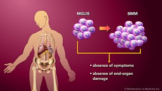 Monoclonal Gammopathy of Undetermined Significance Smoldering Multiple Myeloma and Multiple Myeloma [upl. by Randolf]