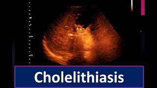 Cholelithiasis  Thickened sludge within the Gall Bladder lumen  Enlarge prostate [upl. by Aronos]