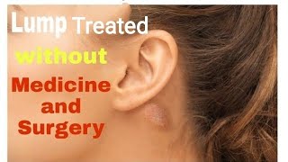 Lump Cyst behind Ear Swollen Glands Adenopathytreated without Medicine and Surgery। Home Remedy [upl. by O'Mahony192]