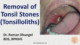 Tonsil Stone Removal  Tonsillolith removal by Dr Raman Dhungel [upl. by Priebe]