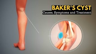 Bakers cyst physio doctor viralvideo kneepain kneepainrelief kneecare aiims orthopedics [upl. by Ilera233]