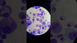 Mesothelial Cells in Pleural Fluid  Body Fluid  Fluids Giemsa Stain [upl. by Ihsakat302]