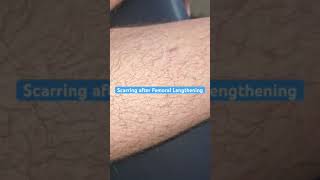 Scarring Femoral Lengthening  3 Months [upl. by Boykins]