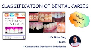 DENTAL CARIES  GV BLACKS CLASSIFICATION  MADE EASY [upl. by Balduin]