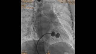 balloon mitral valvotomy in mitral stenosis patient [upl. by Arhat]