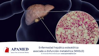 Esteatosis hepática asociada a disfunción metabólica MASLD NAFLD [upl. by Eniretak]