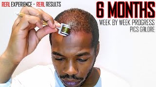 Derma roller Hair Regrowth Results 6 Months  Month by Month Progress  Coffee as a DHT Blocker [upl. by Meras760]