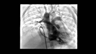 Tetralogy of Fallot RV Angiogram [upl. by Isaak]