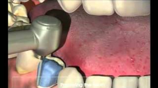 Crowns  Procedure for your new crown at Dental Reflections [upl. by Oeflein]