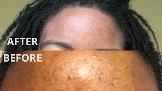 How to treat stubborn acne and get clear skin in 2 weeks  Folliculitis [upl. by Arst]