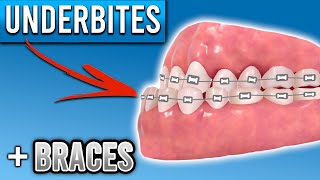 How Do Braces Fix Underbites  Premier Orthodontics [upl. by Yenaled]