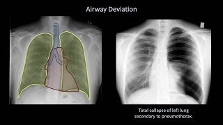 How to Interpret a Chest XRay Lesson 4  Airways Bones and Soft Tissues [upl. by Leba144]