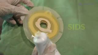 How to apply a stoma bag  Colostomy  Ileostomy bag  Change of stoma bag [upl. by Nospmis]