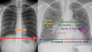 Microcardia in Addisons Disease The Small Heart Syndrome [upl. by Shererd279]