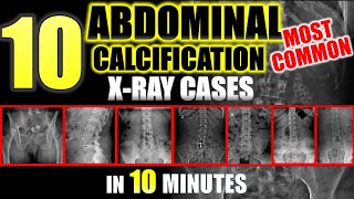 Abdominal Calcifications on XRay  10 Most Common radiology [upl. by Xenia]