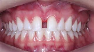 Fechamento Diastema [upl. by Artemahs]