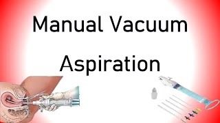 Manual Vacuum Aspiration MVA [upl. by Nannek]