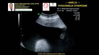 Amelia  Phocomelia syndrome [upl. by Foskett114]