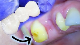 Full Dental Bridge Procedure Step by Step Including the Extraction on a Badly Infected Molar [upl. by Gnivri]