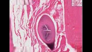 Histopathology Skeletal muscleTrichinosis [upl. by Rama]