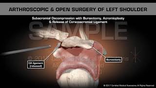 Arthroscopic amp Open Surgery of Left Shoulder [upl. by Reich166]