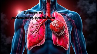 What causes pulmonary embolism Understanding the risks [upl. by Theone58]