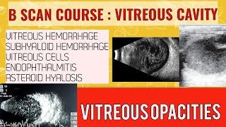 B scan course  learn how to B scan vitreous opacities [upl. by Eidnim]