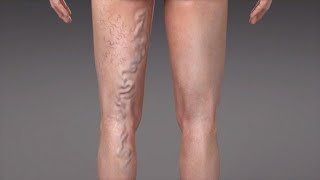 What are Varicose Veins [upl. by Nedak]