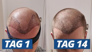 1  14 Tage nach Haartransplantation Der komplette Heilungsverlauf [upl. by Alleunamme]