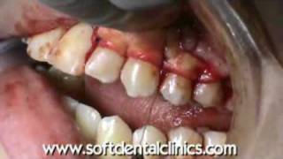 Periodontal Plastic Surgery using AlloDerm for Root Coverage [upl. by Ahsratan]