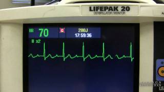 EKG Training Watching and Interpreting the Defibrillator Monitor [upl. by Mcculloch]