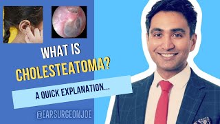 What is Cholesteatoma  an ear surgeon explains [upl. by Marelda413]