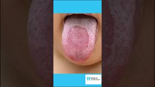 Treatment for Geographic Tongue and 4 Best Practices [upl. by Acirehs395]