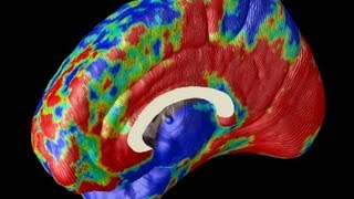 Imaging Alzheimers in the Brain [upl. by Hannasus242]