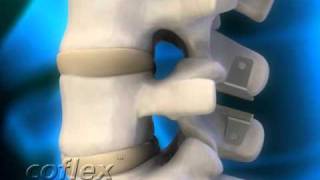 coflex motion spine [upl. by Odlonra]