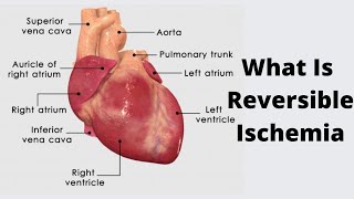 What Is Reversible Ischemia [upl. by Sand]