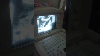 abdominal ultrasound cirrhotic liver cholecystitis with cholelithiasisshortvlog [upl. by Sosthina]