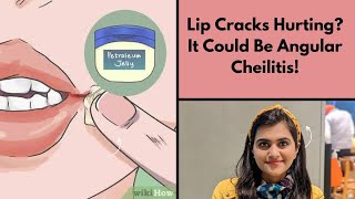 Lip Cracks Hurting It Could Be Angular Cheilitis [upl. by Lakym]