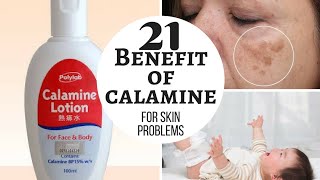 CALAMINE lotion  Lacto calamine lotion uses in detail side effects [upl. by Helbon961]