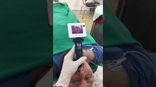 Video Laryngoscopy intubation for an Adult Patient [upl. by Stormi573]